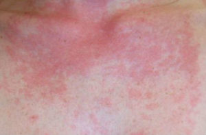 Alergija na sonce - blog